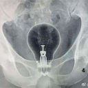 今度は肛門に電球が……!?　中国人の困った異物挿入癖に、担当医がSOS！