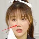 整形手術によって鼻が壊死した中国女優　3カ月ぶりにメディア出演で今の鼻を公開