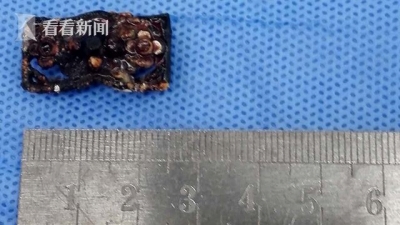 子どもたちを襲う「下半身クライシス」 漏電で陰茎丸焦げ&膣内に髪留め3年間放置の画像4