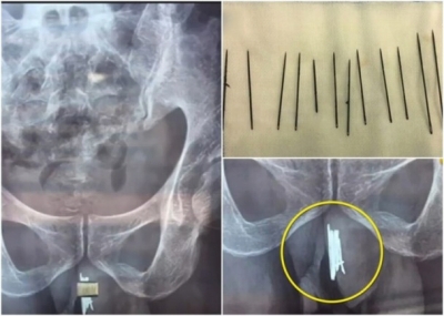1年かけて針15本をアソコへ……アナルだけじゃない、中国人の異物挿入事件の画像1
