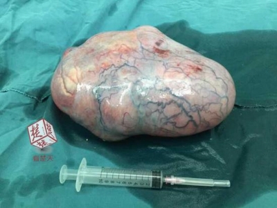 12歳女児の卵巣から6キロの異物が……中国でリアルピノコ巨大奇形腫の出現が相次ぐの画像1
