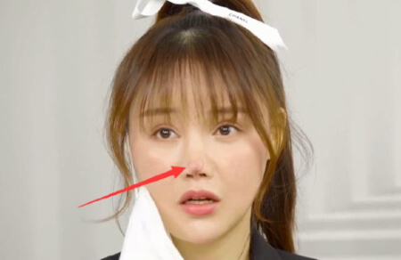 整形手術によって鼻が壊死した中国女優　3カ月ぶりにメディア出演で今の鼻を公開の画像1