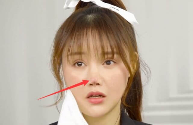 整形手術によって鼻が壊死した中国女優 3カ月ぶりにメディア出演で今の鼻を公開 日刊サイゾー 整形手術によって鼻が壊死した中国女優 3カ月ぶりにメディア出演で今の鼻を公開 日刊サイゾー