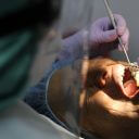 “銀歯”で金属アレルギーが発生 メカニズムを東北大研究Gが解明　
